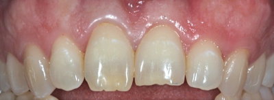 Caso práctico. Carillas de porcelana. Clínica Dental Fernández León