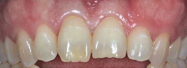 Caso práctico. Carillas de porcelana. Clínica Dental Fernández León