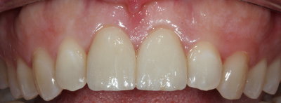 Caso práctico. Carillas de porcelana. Clínica Dental Fernández León