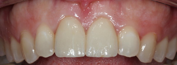 Caso práctico. Carillas de porcelana. Clínica Dental Fernández León