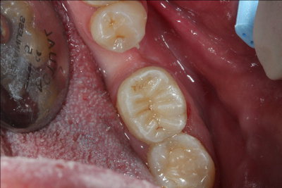 Caso práctico de endodoncia. Clínica Dental Fernández León