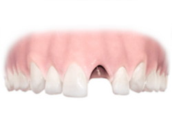 Implantes dentales. Clínica Dental Fernández León