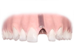 Implantes dentales. Clínica Dental Fernández León