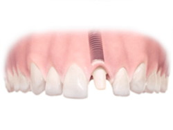 Implantes dentales. Clínica Dental Fernández León