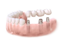 Implantes dentales. Clínica Dental Fernández León