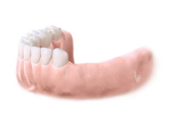 Implantes dentales. Clínica Dental Fernández León