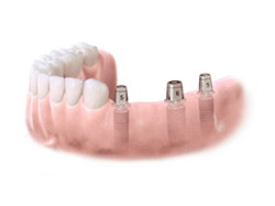 Implantes dentales. Clínica Dental Fernández León