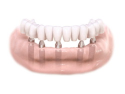 Implantes dentales. Clínica Dental Fernández León