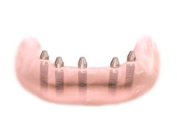 Implantes dentales. Clínica Dental Fernández León