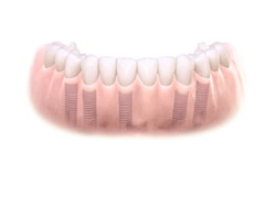 Implantes dentales. Clínica Dental Fernández León