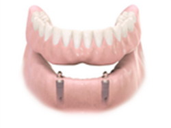 Implantes dentales. Clínica Dental Fernández León